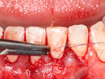 Shire Perio Academy Mucogingival Surgery Module 4